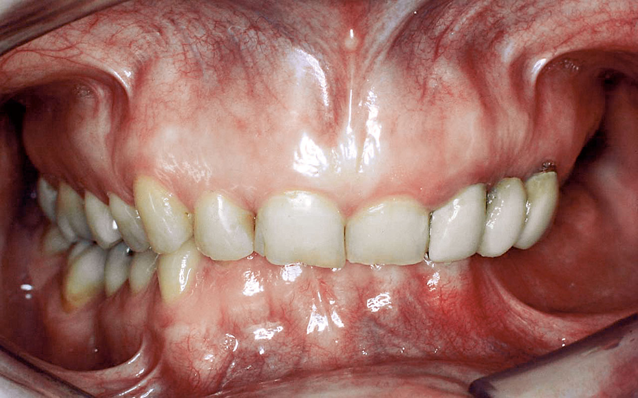 Abb. 4b ... und klinischer Okklusionsbefund einer 60-jährigen Patientin (T2max.mand.-Typ – konvergierende Kieferbasen) mit sich verstärkendem Deckbiss, ausgeprägten Zahnabrasionen und CMD-Problemen infolge von Bruxismus.