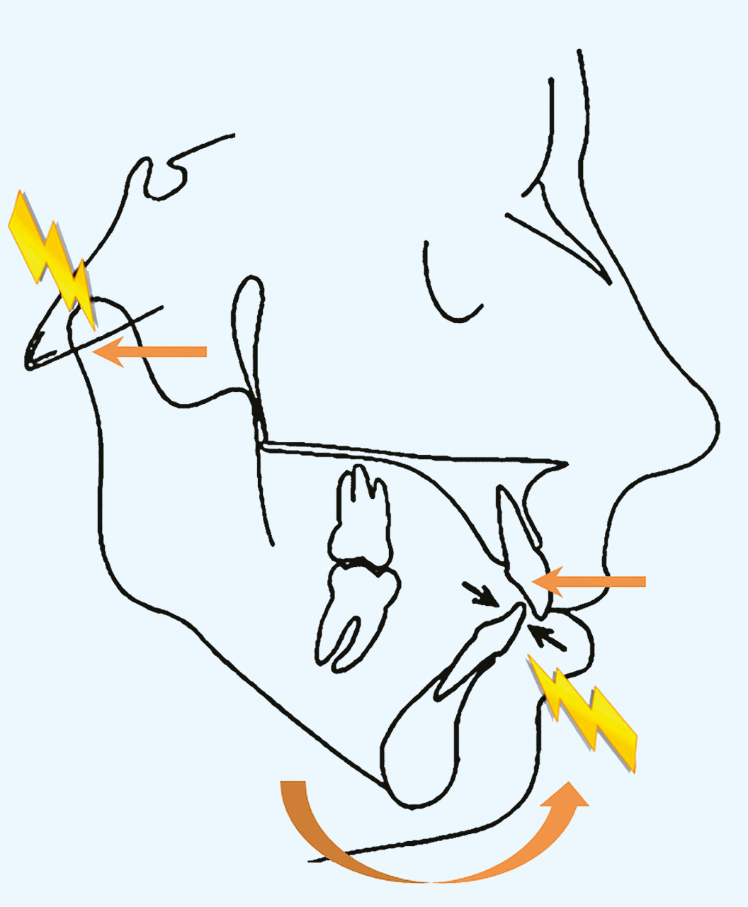 Abb. 5a Patientin im vierten Lebensjahrzehnt mit Schmerzen infolge einer dorsalen Kompression im Kiefergelenk. Die durch einen festsitzenden lingualen Drahtretainer fixierte untere Front kollidiert mit den sich im Alter nach dorsal aufrichtenden oberen Inzisivi.