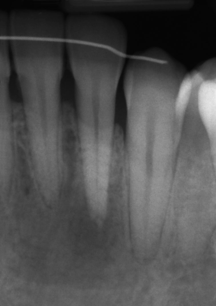 Abb. 7a Röntgenbild Zahn 32 vor der Extraktion.