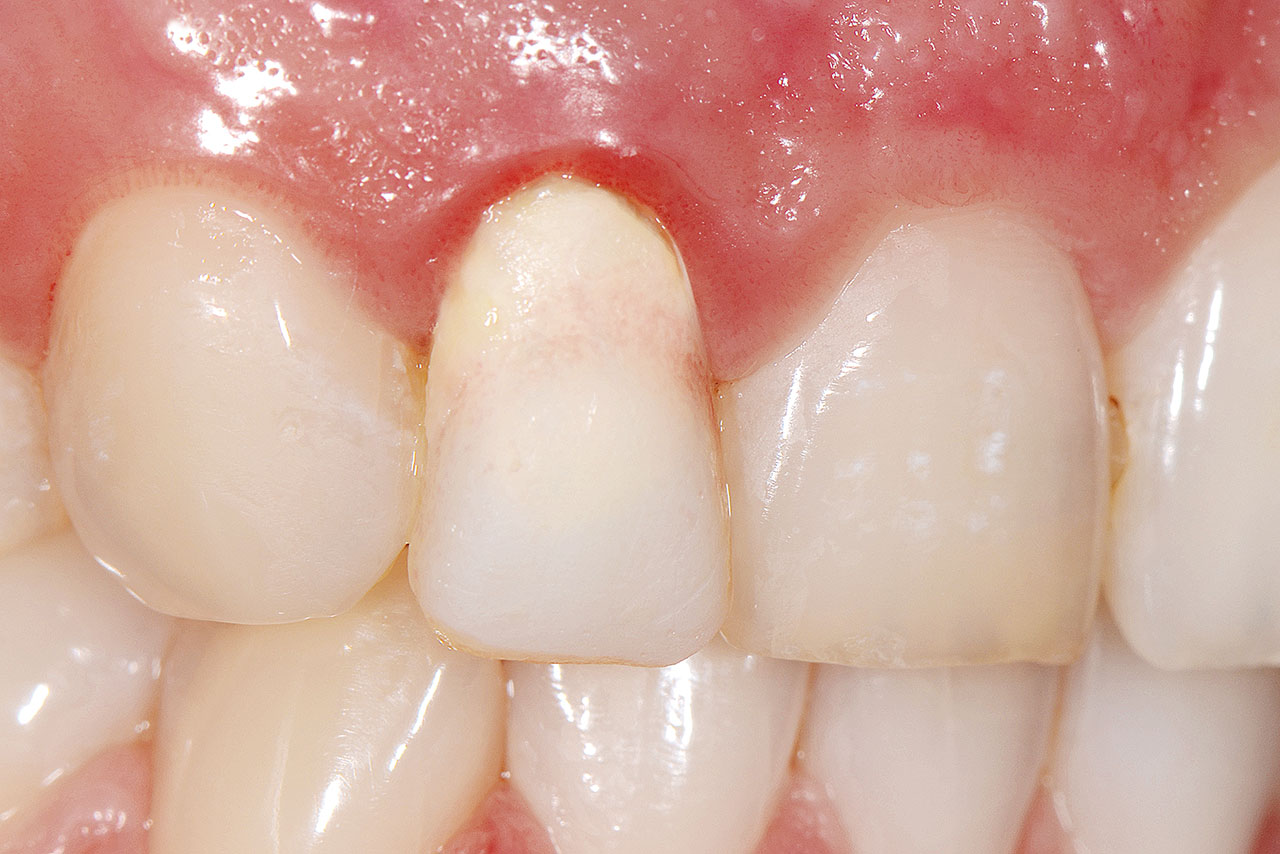 Abb. 8 Ausgangssituation: Zahn 12 provisorisch versorgt, tief reichender Defekt.