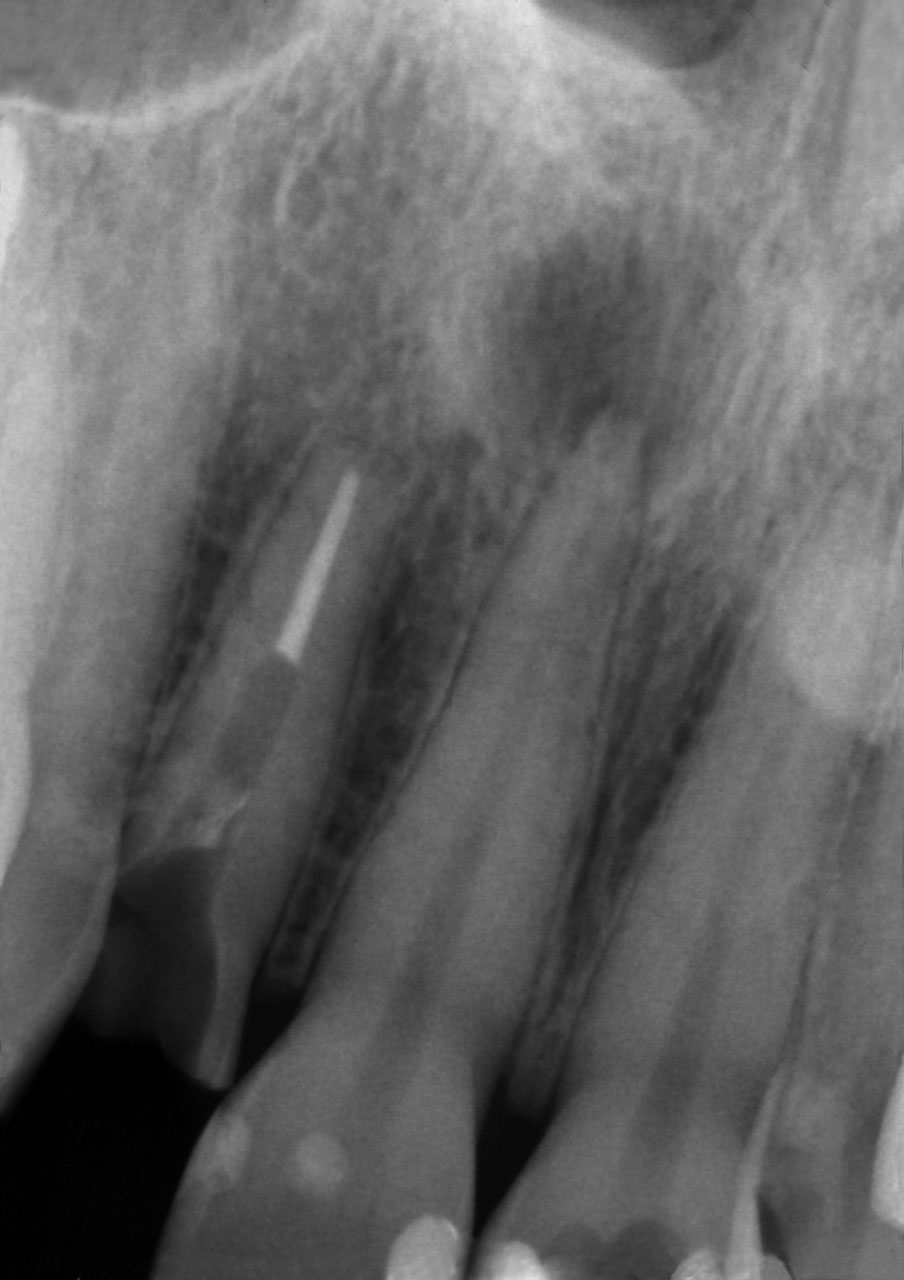 Abb. 15a Röntgenbild der Ausgangssituation: tief reichender Defekt an Zahn 12, 
apikale Parodontitis an Zahn 11.