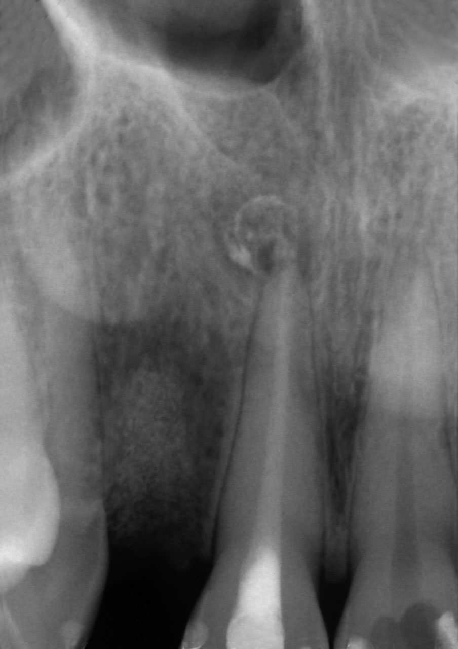Abb. 15b Röntgenbild nach Extraktion von Zahn 12 und Wurzelkanalfüllung an Zahn 11.