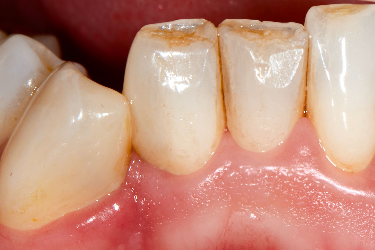 Abb. 18 Zustand 6 Monate nach Lückenschluss mittels Kompositverbreiterungen der Zähne 41 und 43.