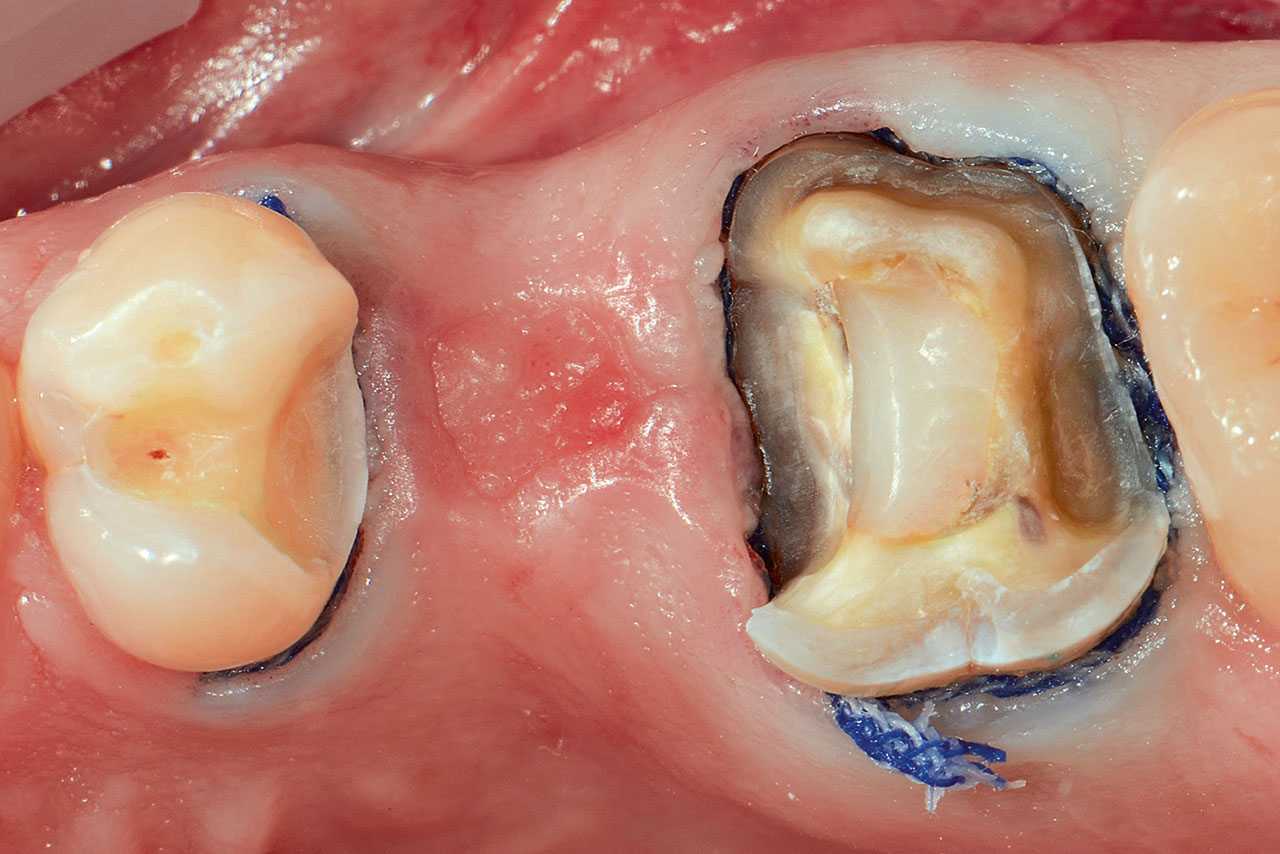 Abb. 22 Ausgangsituation 3 Monate nach Extraktion von Zahn 26, defektorientierte Präparation der Zähne 27 und 25.