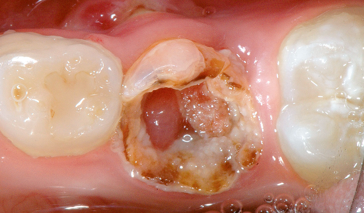 Abb. 2a Dentogene Infektionen der Milchzähne, die der pufa-Index21 erfasst: visuell erkennbare Pulpaeröffnung an Zahn 75, ...