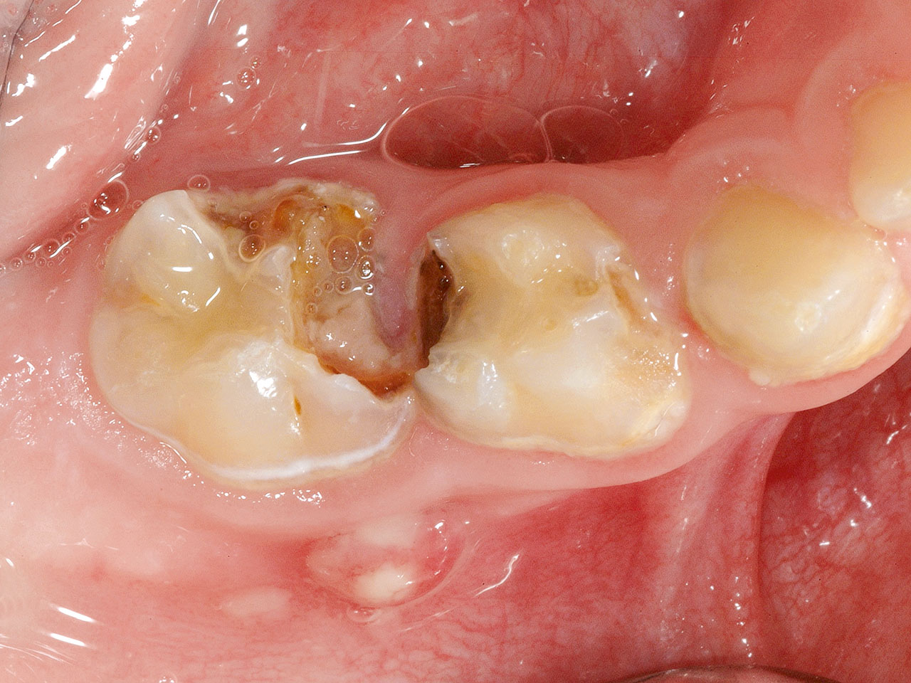 Abb. 2d ... sowie dentaler Abszess ausgehend von Zahn 85.
