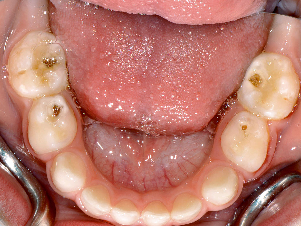 Abb. 4b Im Unterkiefer des Patienten weisen alle Milchmolaren profunde kariöse Läsionen auf; marginale Plaqueablagerungen sind an sämtlichen Zähnen erkennbar.