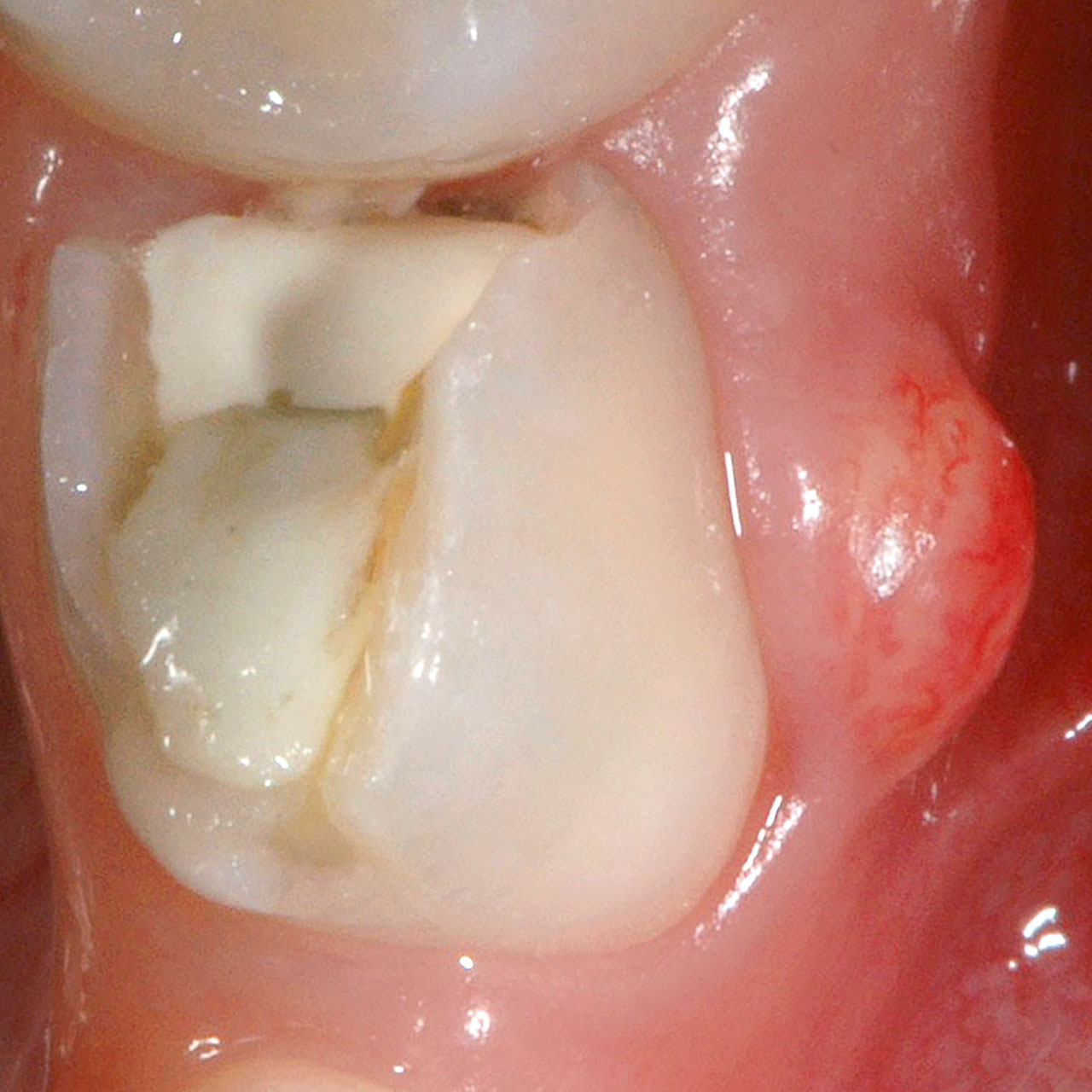 Abb. 5 Pusentleerung aus dem trepanierten Pulpakavum von Zahn 74 und rezidivierende Abszedierung infolge unterlassener Extraktion des Zahns als Kausaltherapie.
