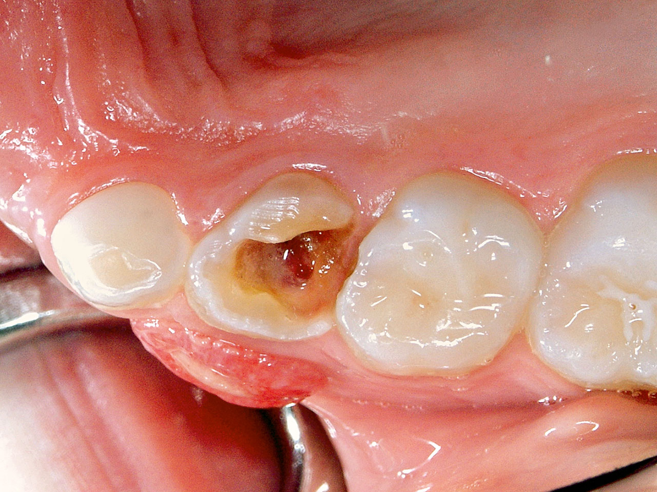 Abb. 6a Trepanierter, aus der Okklusion geschliffener Zahn 64 mit Fistel und Granulationsgewebe im Vestibulum eines 6-jährigen Patienten.