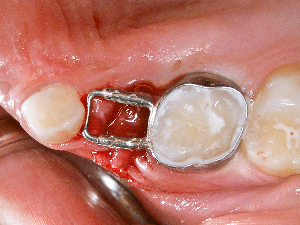 Abb. 6b Zustand nach Extraktion des Zahns 64 und sofortiger Eingliederung eines festsitzenden Lückenhalters.