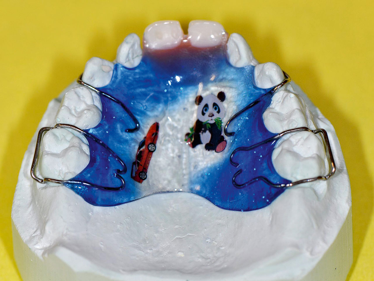 Abb. 8c Kinderprothese zum Ersatz der Zähne 51 und 61 sowie Adams-Klammern an den zweiten Milchmolaren und C-Klammern an der Milcheckzähnen zur Verankerung.