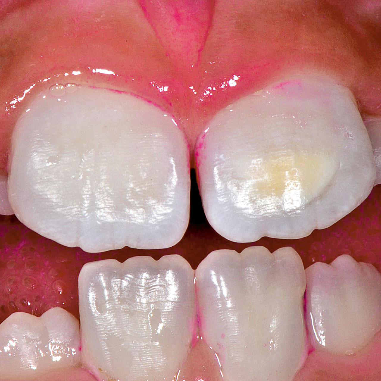 Abb. 9a Turner-Zahn 21 – abgegrenzte Opazität nach chronisch apikaler Parodontitis an Zahn 61.