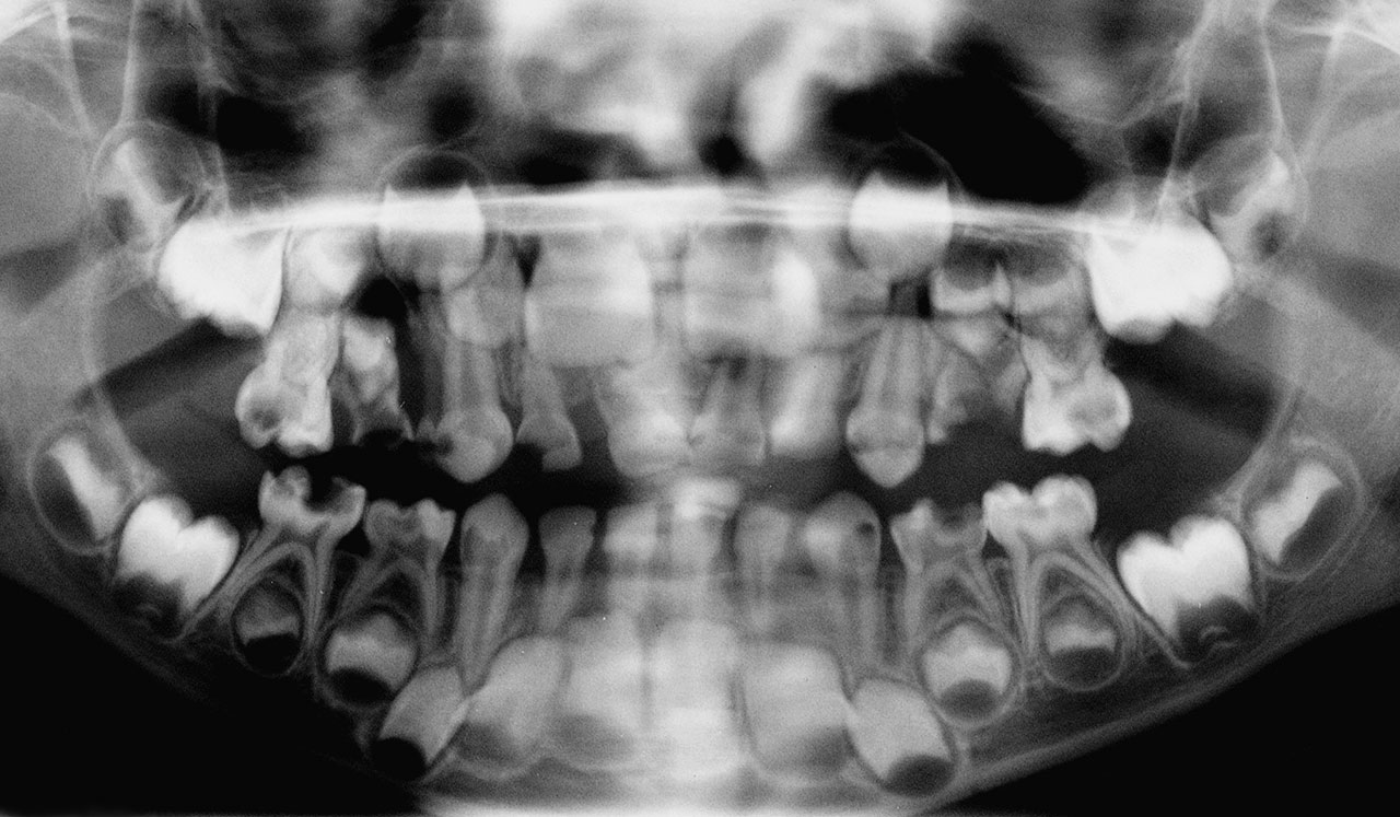 Abb. 9b Panoramaschichtaufnahme eines 4-jährigen Patienten mit schwerer frühkindlicher Karies. Es sind alle Milchzähne kariös betroffen. Am Zahn 54 besteht ein ausgedehnter osteolytischer Prozess, der die Zahnanlage 14 umschließt. Weiterhin liegt an den Zähnen 61 und 64 eine apikale Parodontitis vor.