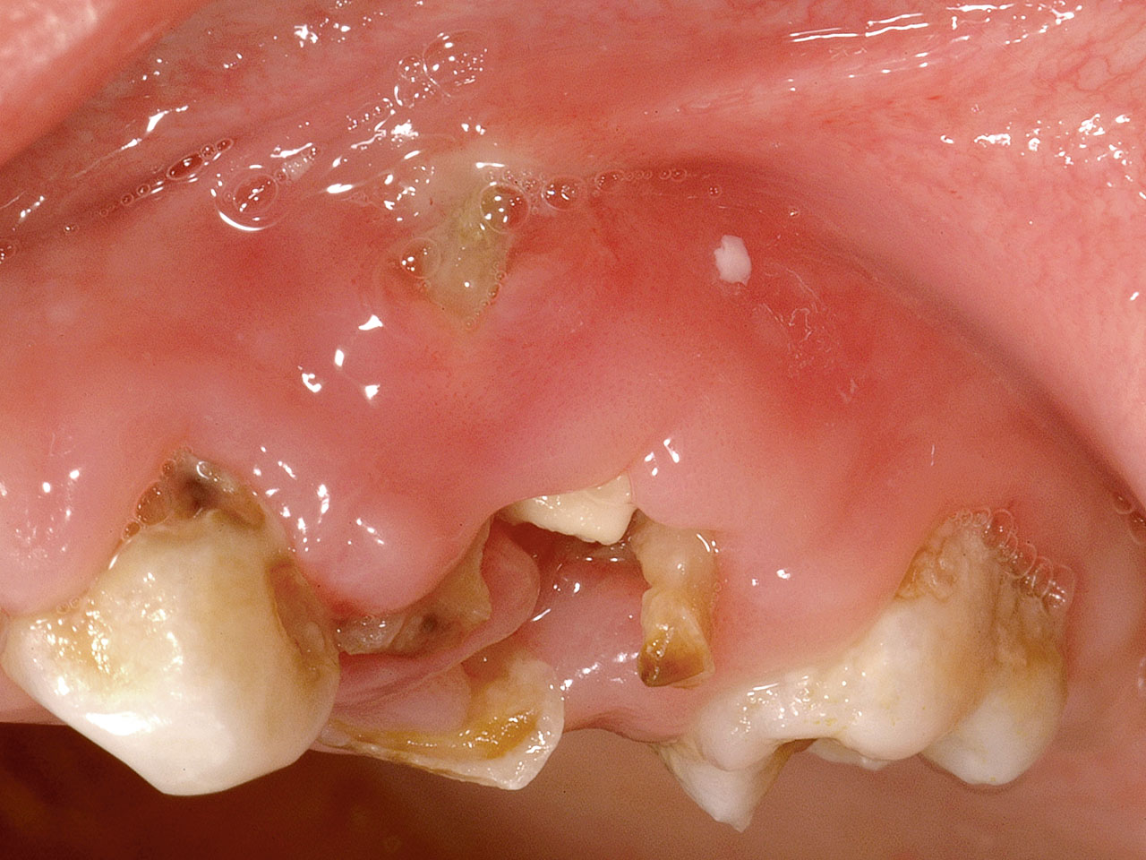 Abb. 9c Die klinische Situation in Regio 54 zeigt die orale Freilegung des Zahnkeims 14 und die infolge des osteolytischen Prozesses an Zahn 54 bukkal exponierte Wurzelspitze.