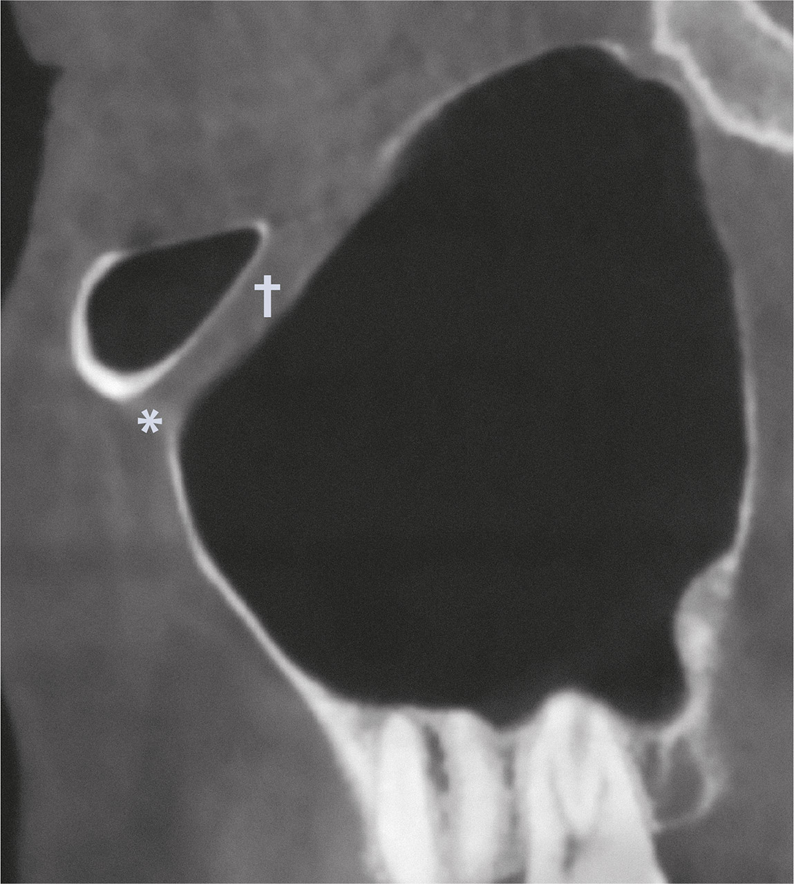 Abb. 1b DVT – schräg-sagittale Ansicht. Darstellung der rechten Kieferhöhle mit Foramen infraorbitale (*) und Canalis infraorbitalis (†).
