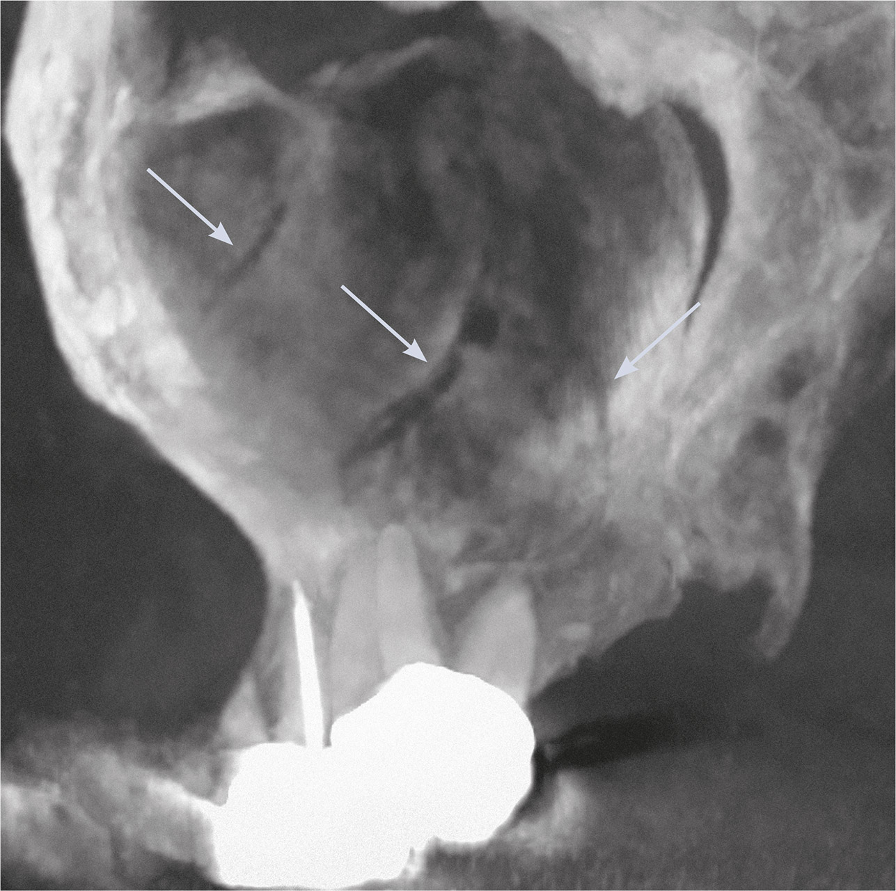 Abb. 1c DVT – schräg-sagittale Maximumintensitäts­projektion der dorsalen Kieferhöhlenwand. Die Pfeile weisen auf Gefäßkanäle in der Wand hin.