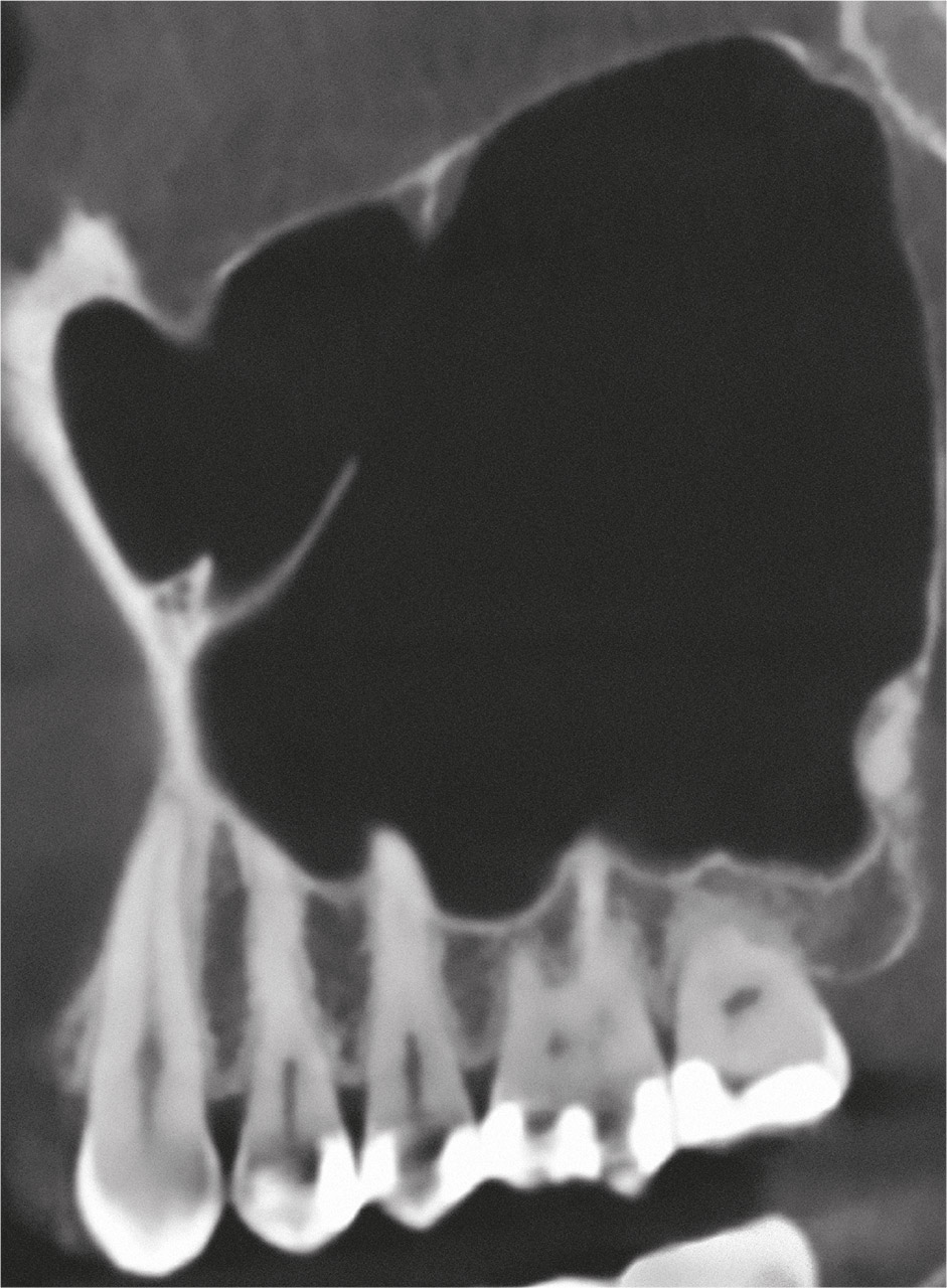Abb. 2a DVT – schräg-sagittale Ansicht. Hyperplasie der rechten Kieferhöhle.