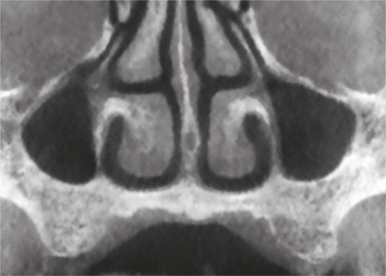 Abb. 3b DVT – koronale Ansicht. Hypoplasie beider Kieferhöhlen. Beachte den deutlich vergrößerten Alveolarfortsatz auch in zahnlosen Regionen.