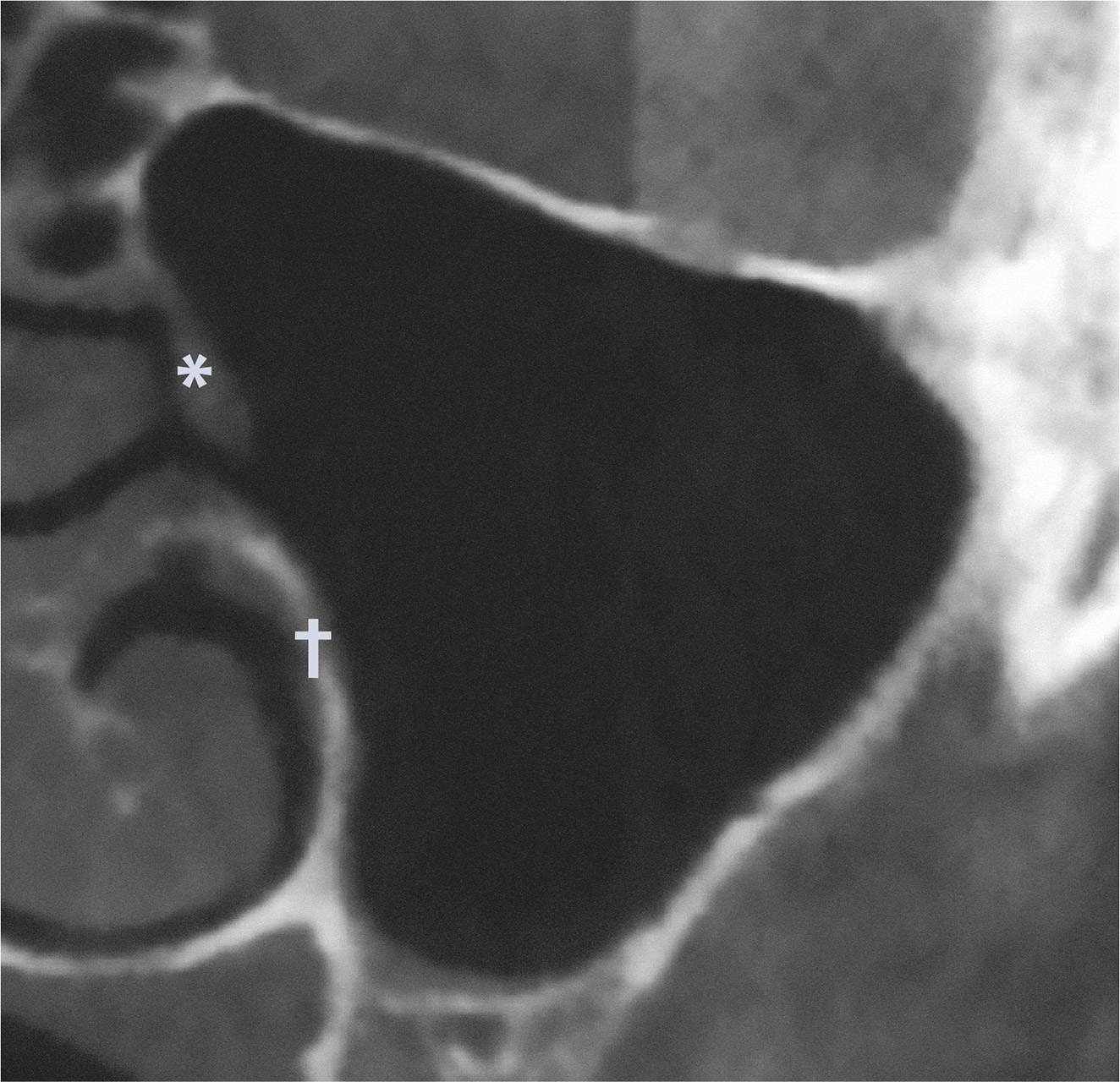 Abb. 4a DVT – koronale Ansicht. Akzessorisches Ostium der medialen Kieferhöhlenwand zwischen Processus uncinatus (*) und knöchernem Ansatz der Concha nasalis inferior (†).