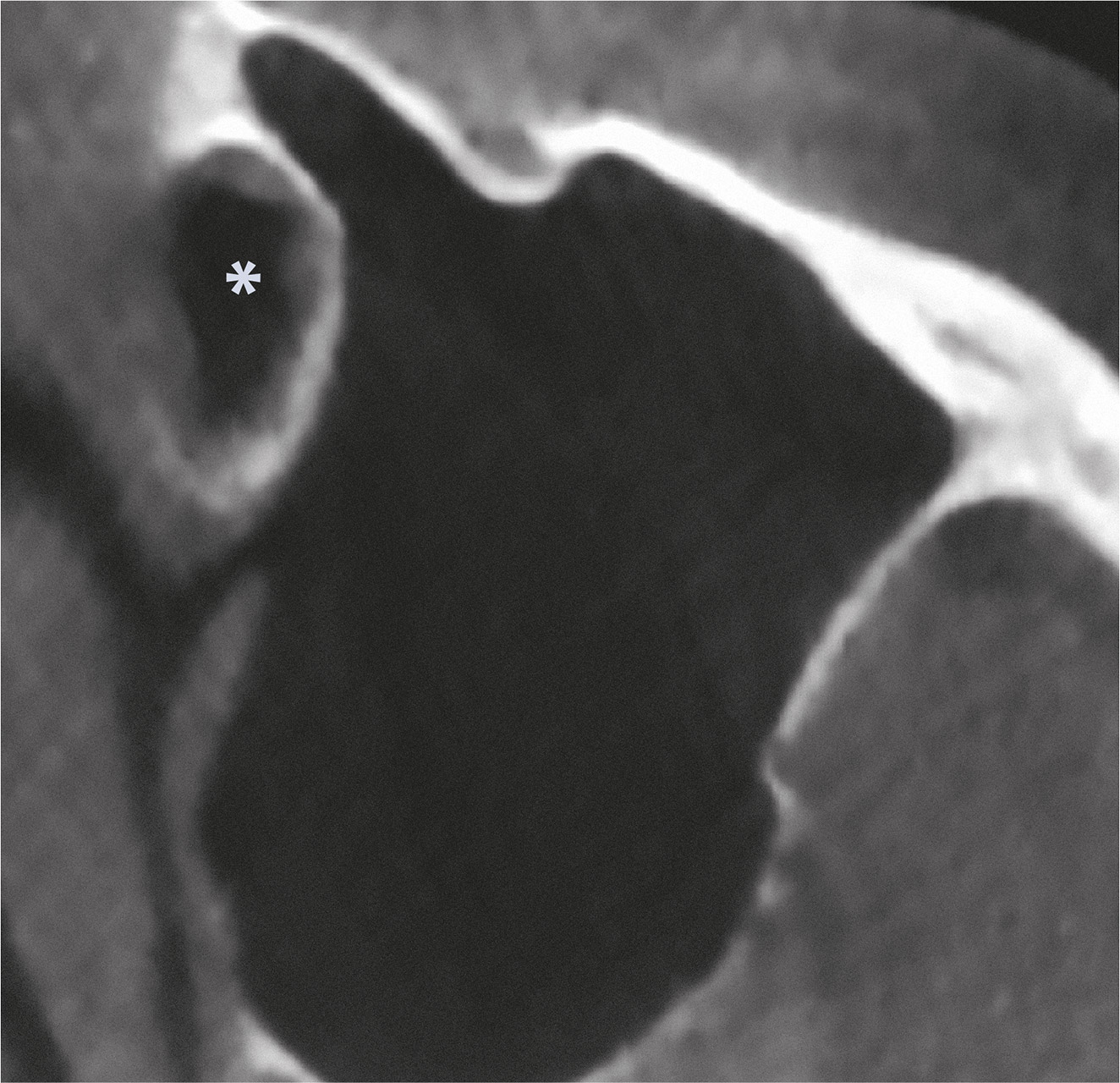 Abb. 4b DVT – axiale Ansicht. Akzessorisches Ostium der medialen Kieferhöhlenwand direkt dorsal des kaudalen Anteils des Ductus nasolacrimalis (*).