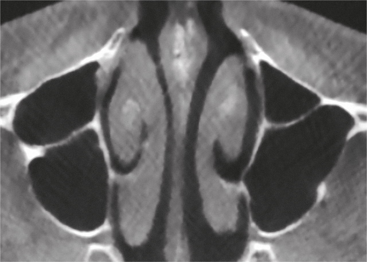 Abb. 5a DVT – axiale Ansicht. Nachweis knöcherner Septen in beiden Kieferhöhlen.