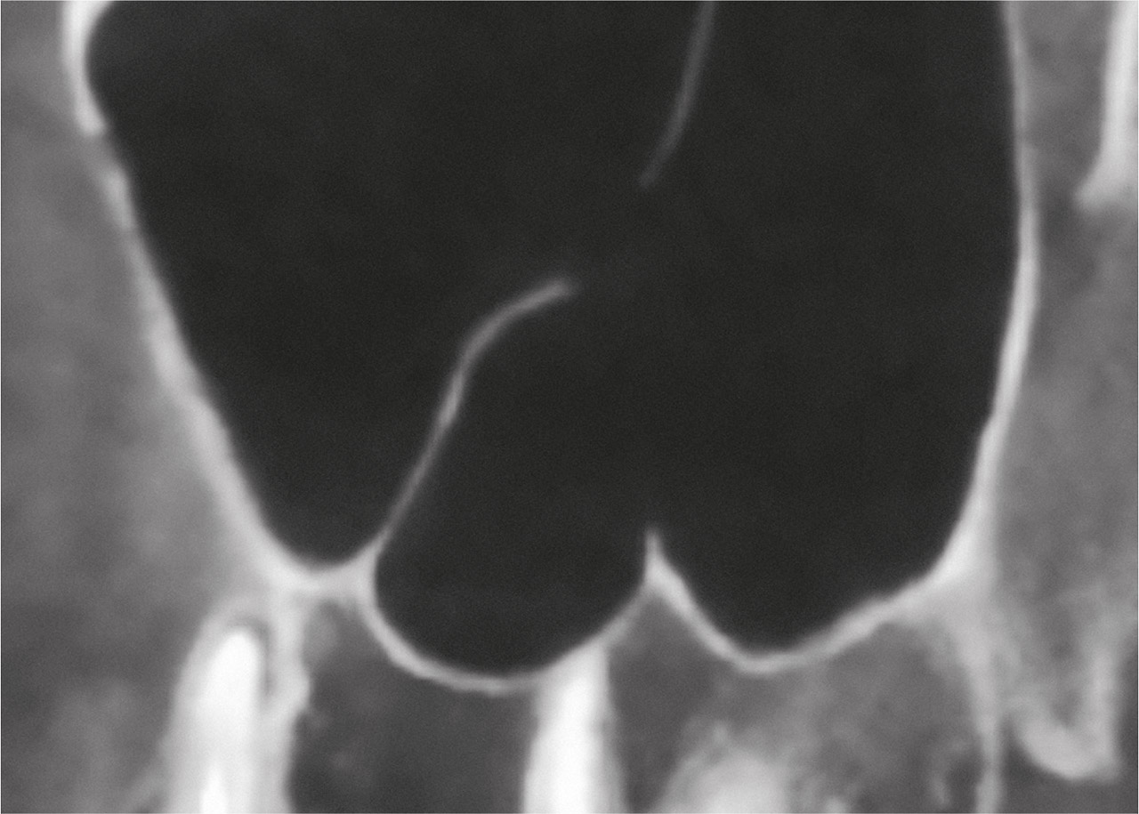 Abb. 5b DVT – sagittale Ansicht. Große septale Strukturen in der rechten Kieferhöhle.