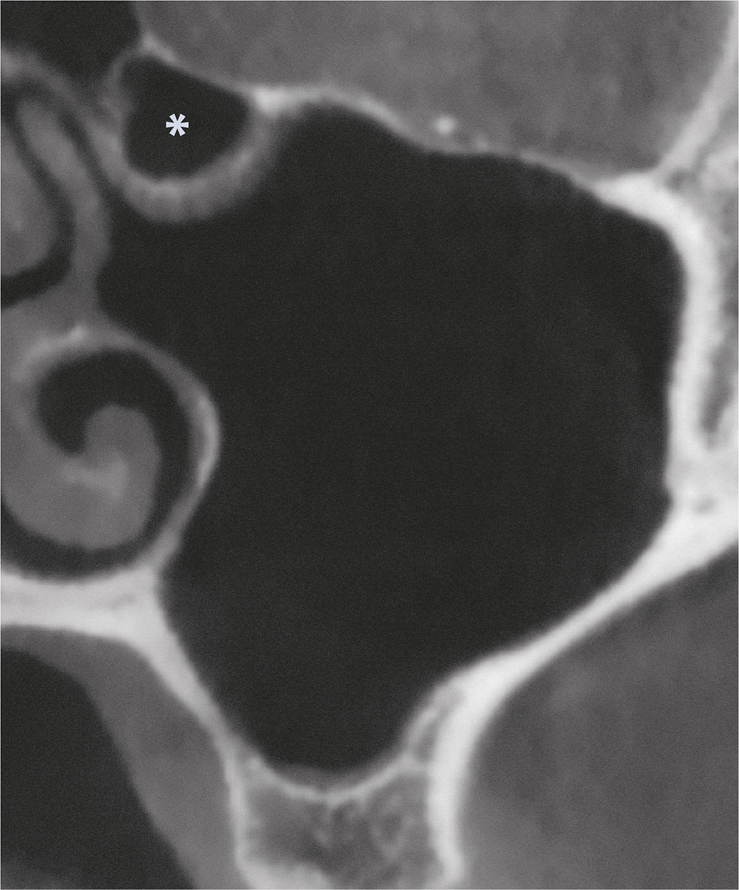 Abb. 6 DVT – koronale Ansicht. Nachweis einer direkt an Ostium und Infundibulum ethmoidale angrenzenden Haller-Zelle (*).