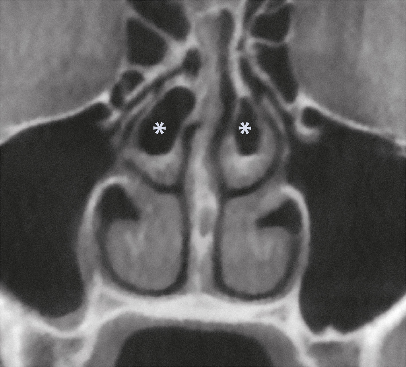 Abb. 7 DVT – koronale Ansicht. Nachweis einer Concha bullosa beiderseits des Septums (*).