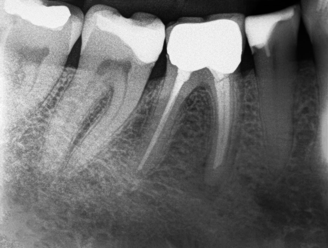 Abb. 3a Röntgenaufnahme eines alio loco behandelten Zahnes mit einer symptomatischen apikalen Parodontitis und insuffizienter Wurzelkanalfüllung. Die mesialen Kanäle waren nicht bis zum Apex und das distale Kanalsystem nicht genügend dicht gefüllt. Füllmaterialien waren Guttapercha und ein Epoxidharz-Sealer, welcher erfahrungsgemäß nicht einfach zu entfernen ist.