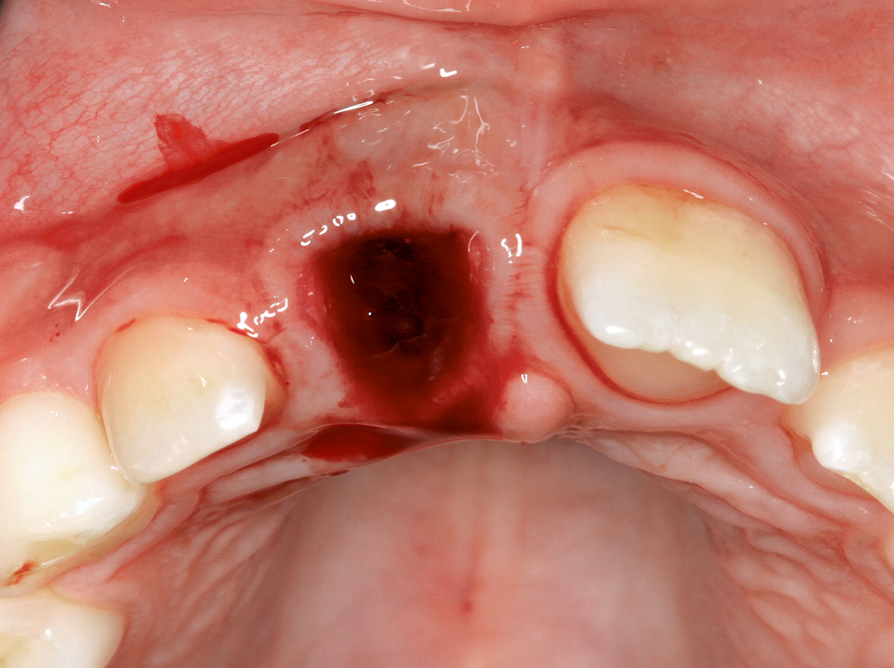 Abb. 4 Intraorale Situation nach Avulsion des Zahnes 11 bei einer 10-jährigen Patientin.