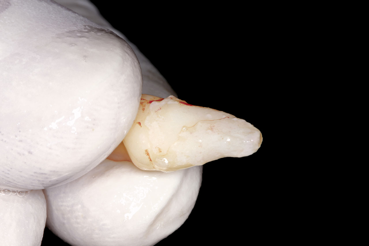 Abb. 5 Extraorale Inspektion der Wurzel: Das Wurzel-wachstum des Zahnes 11 ist noch nicht abgeschlossen, das Foramen apicale jedoch kleiner als 2 mm.