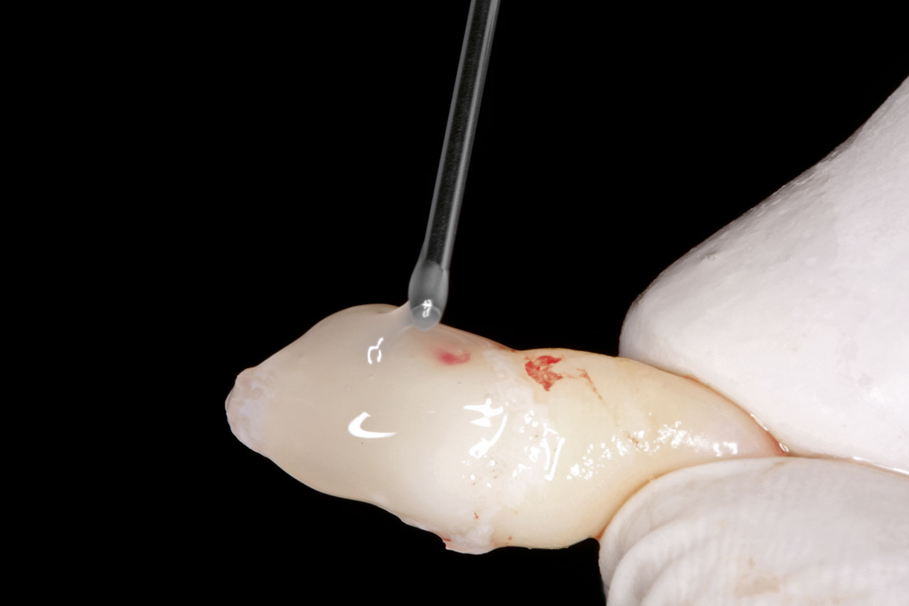 Abb. 6 Applikation von Emdogain aufgrund der sub­optimalen Zahnrettung.