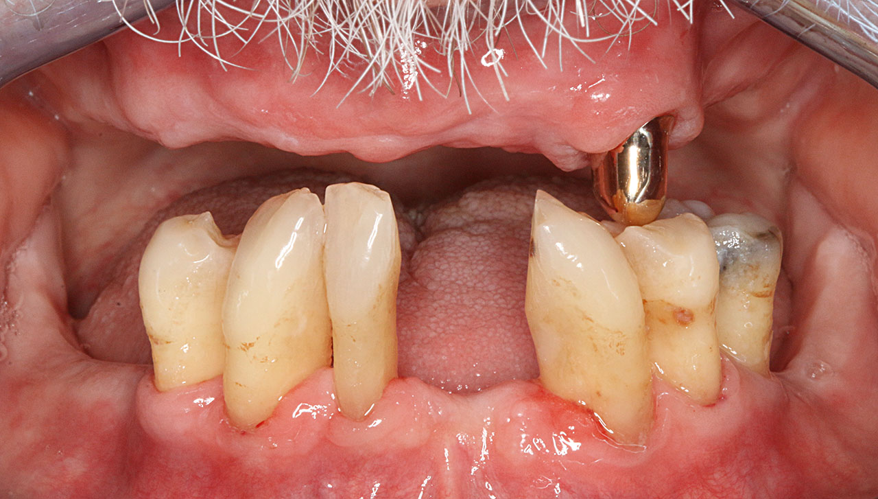 Abb. 2a Typisches Bild eines reduzierter Zahnbestandes bei einem Senior ohne ...