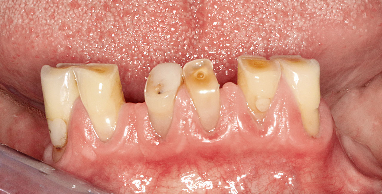 Abb. 3b Deutlicher Verschleiß an den Unterkieferinzisivi einer Seniorin mit reduziertem Zahnbestand. Es liegen primär Attritionen vor. Die Patientin hatte keine Beschwerden, jedoch ist die Funktionsfähigkeit der Zähne stark eingeschränkt