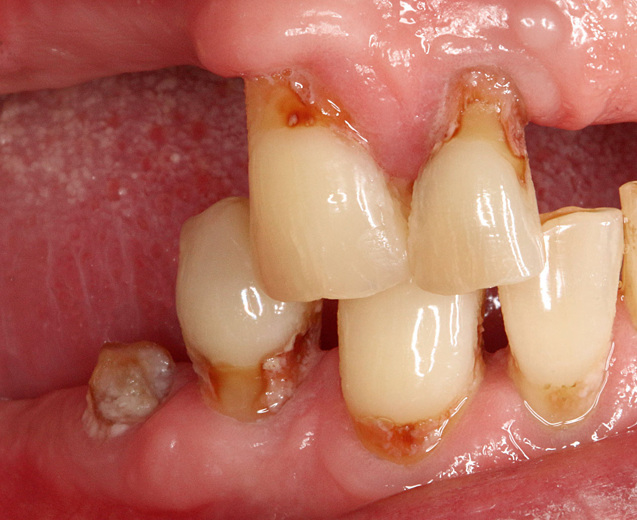 Abb. 5 Multiple Wurzelkaries bei einem Senior mit schlechter Mundhygiene.
