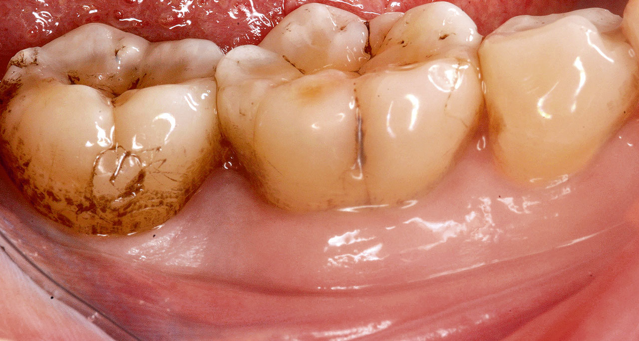 Abb. 4a Beispiel einer regenerativen Therapie mittels Papillenamplifikationslappen an Zahn 46. Klinischer Ausgangszustand.