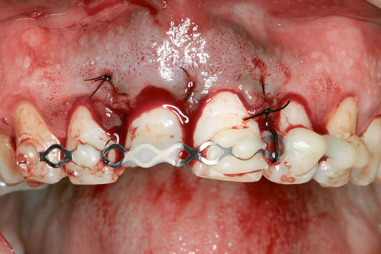 Abb. 10 Klinische Situation nach Replantation und Schienung des Zahnes 21.