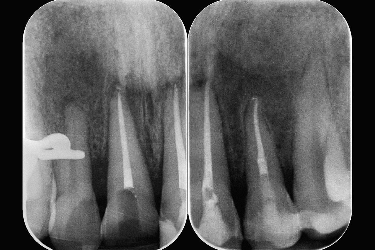 Abb. 12 Radiologische Kontrolle 1 Monat nach dem Unfall: periradikuläre Aufhellungen an den Zähnen 12, 11 und 21 im Rahmen der Knochenremodellierung.