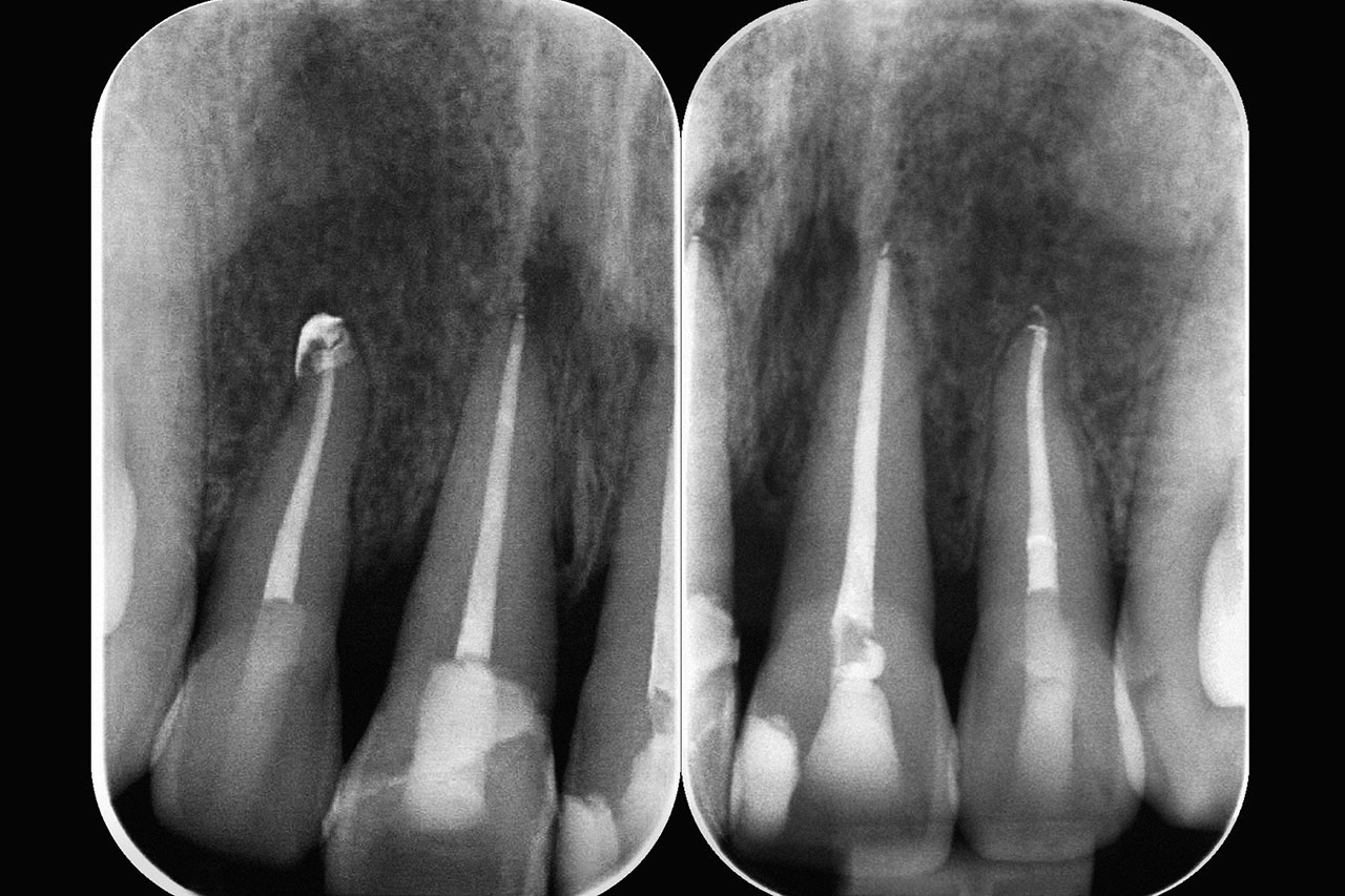 Abb. 16 Radiologische Kontrolle 6 Monate nach dem Unfall: Zahn 21 mit partiell unscharf begrenztem Parodontalspalt.
