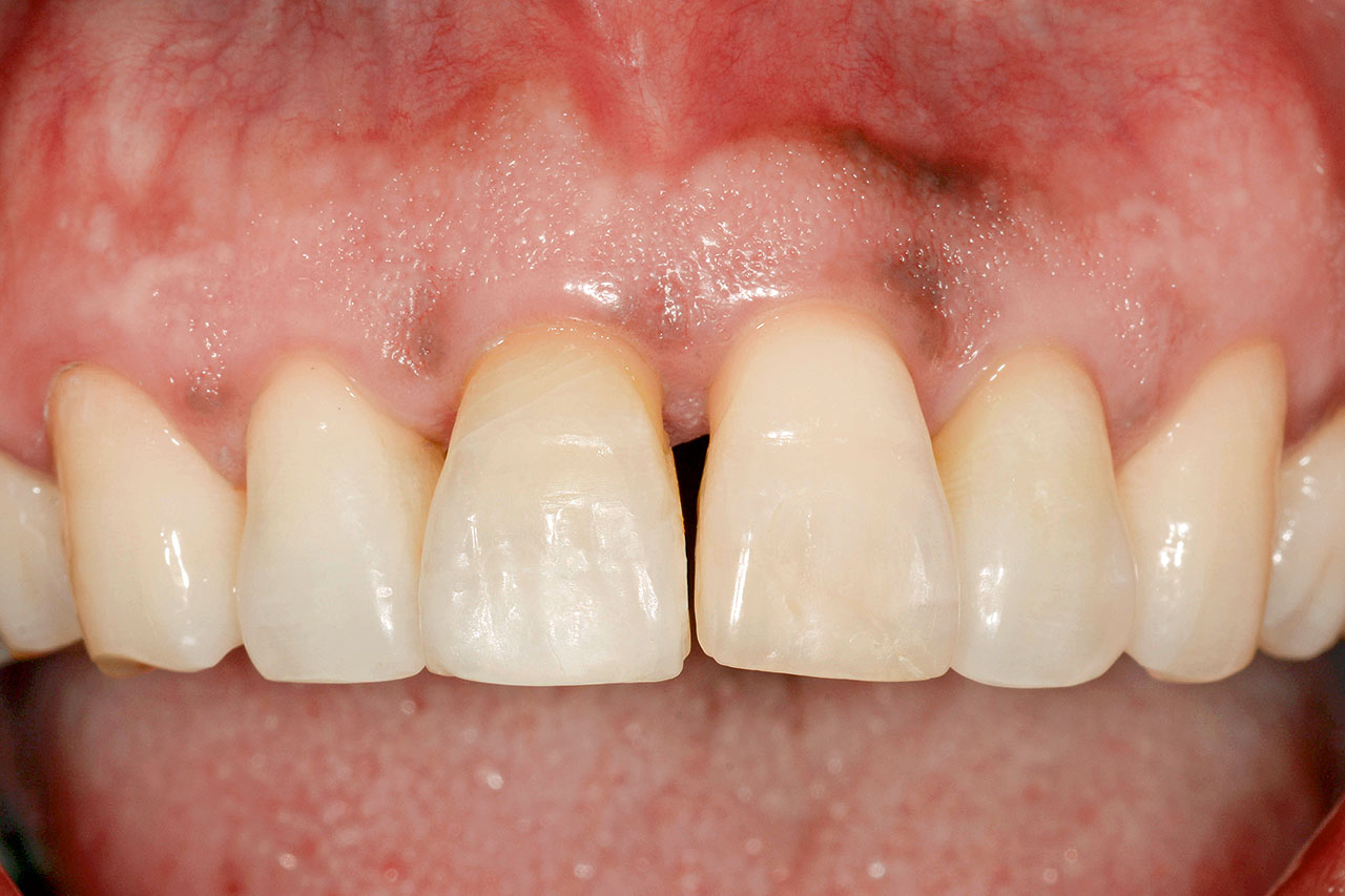 Abb. 17 Klinische Situation 1 Jahr nach dem Unfall: Die Zähne 11 und 21 waren ankylosiert.