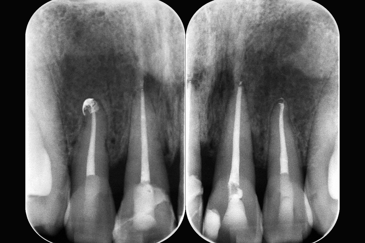Abb. 18 Radiologische Kontrolle 1 Jahr nach dem Unfall: Ersatzgewebsresorptionen an den Zähnen 11 und 21.