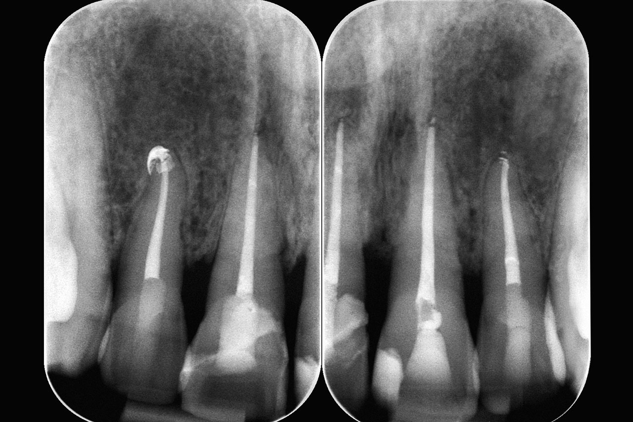 Abb. 20 Radiologische Kontrolle 2 Jahre nach dem Unfall: geringe Progredienz der Ersatzgewebsresorptionen an den Zähnen 11, 21 und 22.