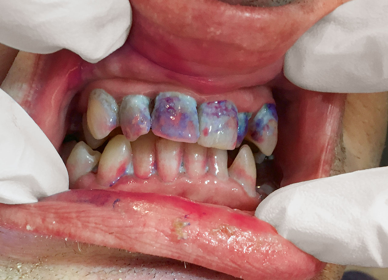 Abb. 2b Harte und weiche Beläge bei einem 84-jährigen Patienten mit beginnender Demenz, dessen Mundhygiene vom Pflegepersonal durchgeführt wird.