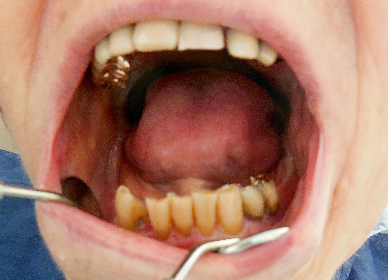 Abb. 1a bis l Intraorale Bilder vor und nach durchgeführter professioneller Zahnreinigung im Pflegeheim. Die durchschnittliche Dauer lag bei 37 Minuten, und die Zieldefinition waren makroskopisch saubere Mundverhältnisse<sup>6</sup>.