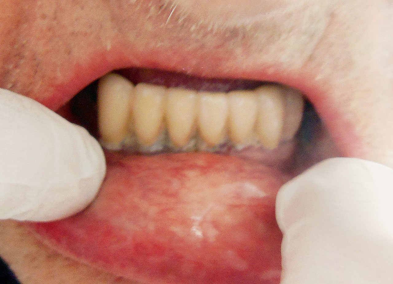 Abb. 1c Intraorales Bild vor durchgeführter professioneller Zahnreinigung im Pflegeheim.