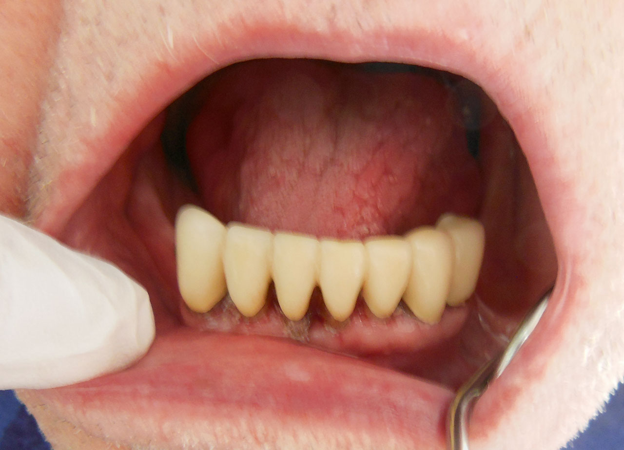 Abb. 1d Nach durchgeführter professioneller Zahnreinigung