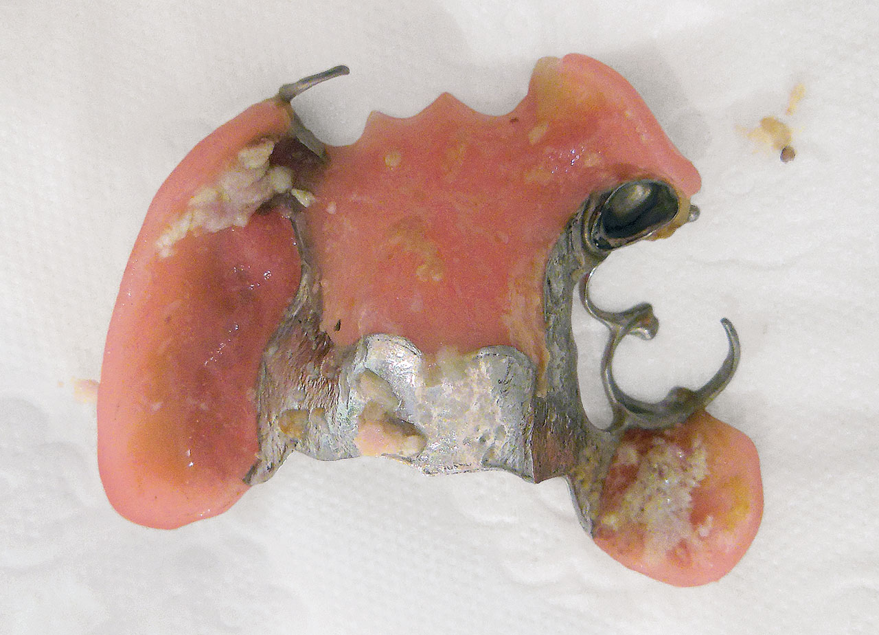 Abb. 1e herausnehmbarer Zahnersatz vor durchgeführter professioneller Zahnreinigung im Pflegeheim.