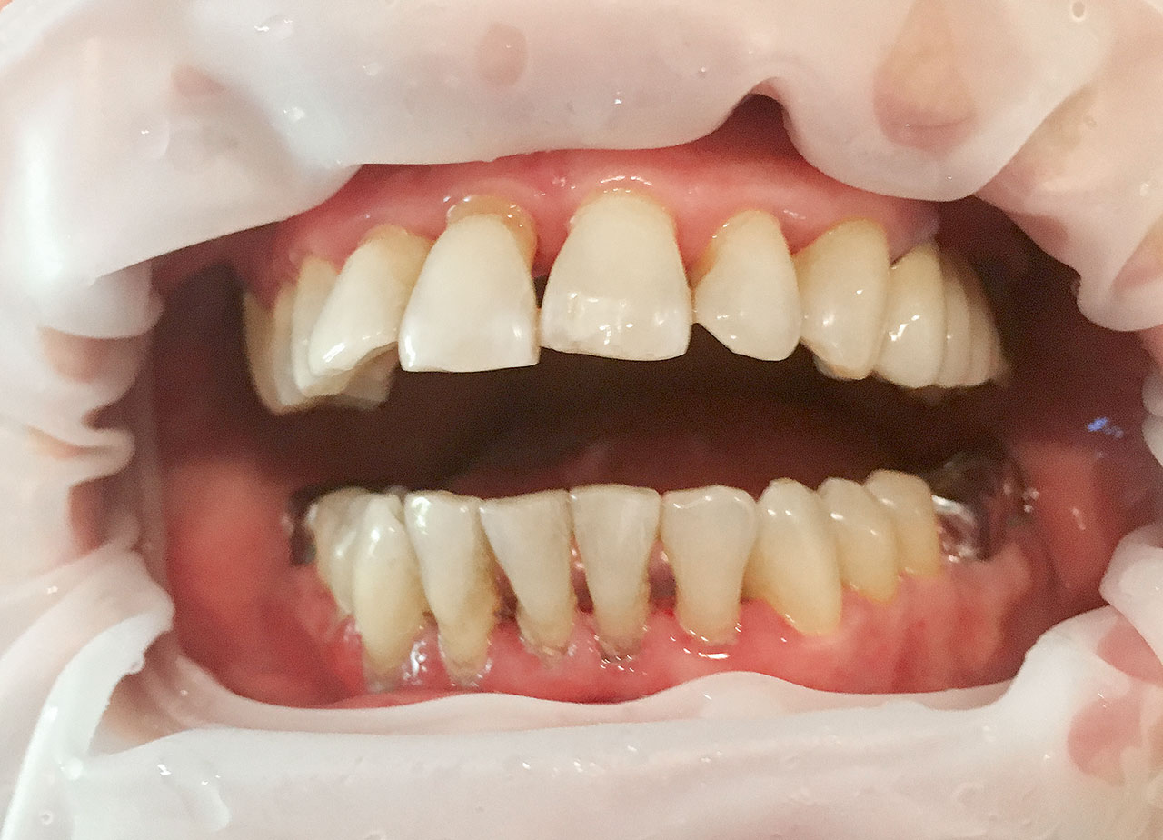 Abb. 1h nach durchgeführter professioneller Zahnreinigung