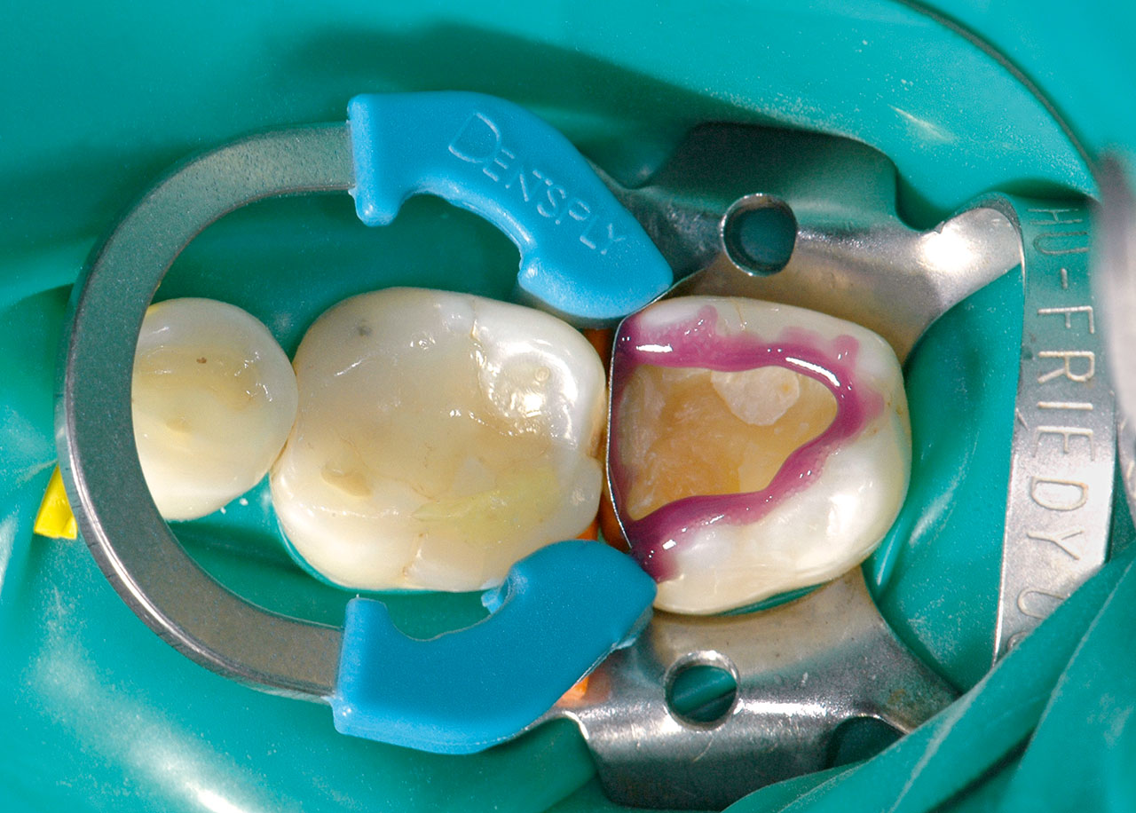 Abb. 8 Schmelzkonditionierung im Rahmen des Etch-and- Rinse-Verfahrens (Gel Etchant, Fa. Kerr Dental, Rastatt), das Dentin wurde anschließend für 15 Sekunden konditioniert.