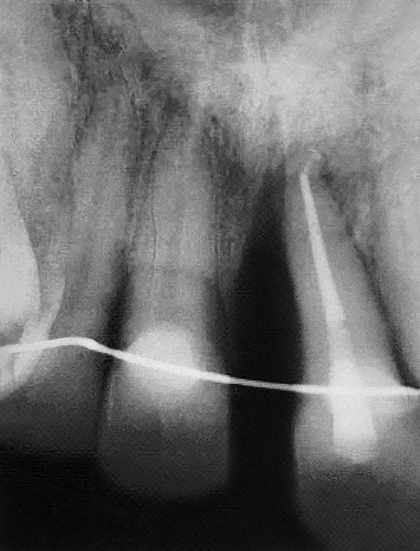Abb. 4 Zähne 21/22 nach endodontischer Therapie in Regio 21.